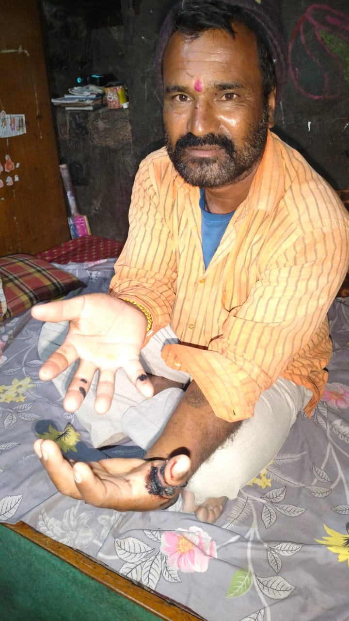 घाटनांदूरमध्ये पिसाळलेल्या कुत्र्यांचा धुमाकूळ!०४-०७ नागरिक जखमी, फोनवर कळवूनही सरपंचांचे दुर्लक्ष